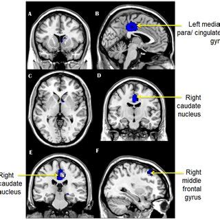 A F Brain Areas That Showed Decreased Grey Matter Volume In MTBI