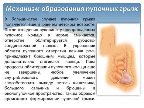 Пупочные грыжи. Герниопластика без натяжения - презентация онлайн