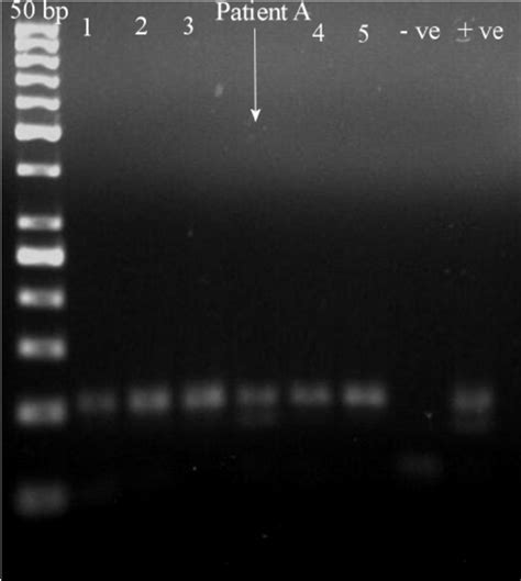 Representative Gel Electrophoresis Image Of PCR RFLP Analysis For