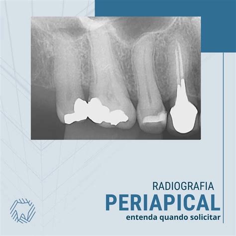 Raio X Periapical Valor