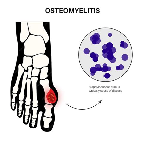 Enfermedad De Osteomielitis Dolor De Huesos De Pies Infectados Y