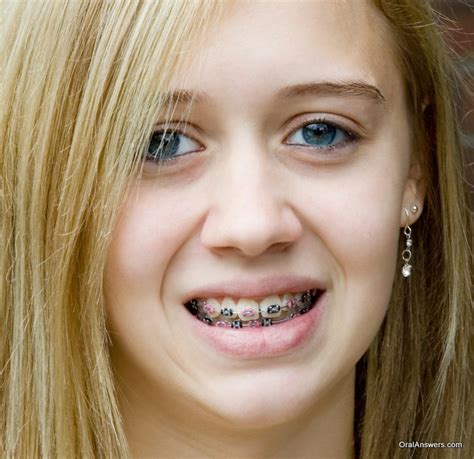 60 Photos of Teenagers with Braces - Robweigner's blog