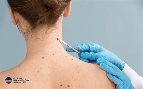 A Guide To Mohs Surgery Florida Dermatology Specialists Blog