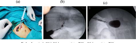 Figure 1 From Short And Long Term Outcomes After Kasai Operation For