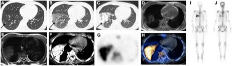 Progressive Metastatic Pulmonary Calcification Ct Mr And Bone Scintigraphy Archivos De