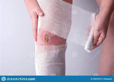 Woman Independently Bandages Her Leg With A Bandage Stock Image Image