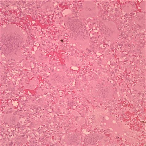 Histologic Image Of Phosphaturic Mesenchymal Tumor Displaying