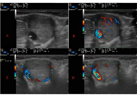 Brachial Vein Ultrasound