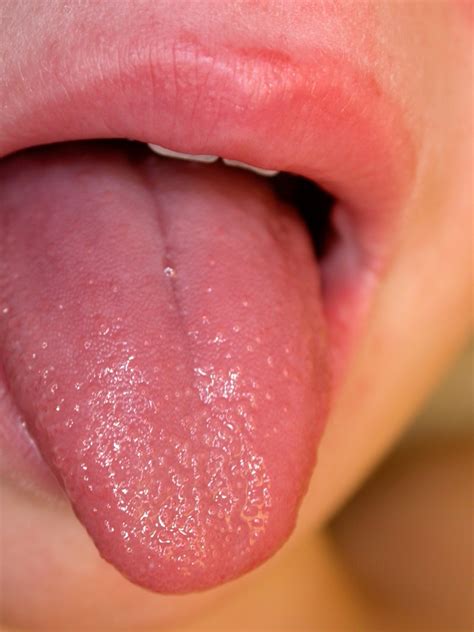 Kawasaki Disease Strawberry Tongue