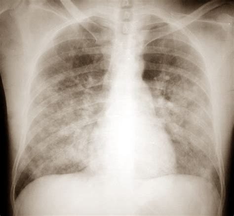 Pulmonary Edema - Pictures, Symptoms, Treatment, Causes, Diagnosis