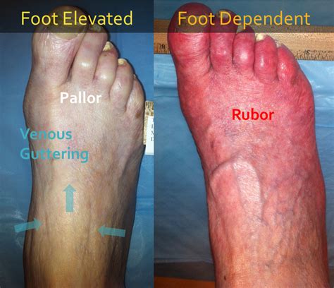 Clinical Evaluation Of The Foot For Peripheral Arterial Disease