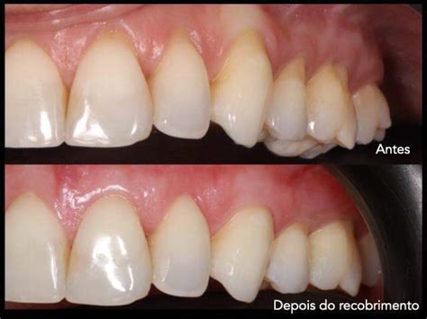 Retração Gengival Volta Ao Normal - Retracao Gengival Antes E Depois Sensibilidade Nas Gengivas Clínica