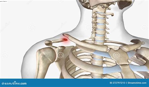 A Clavicle Fracture Is A Break In The Collarbone One Of The Bones In