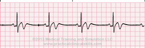 Sinus Rhythm ECGs