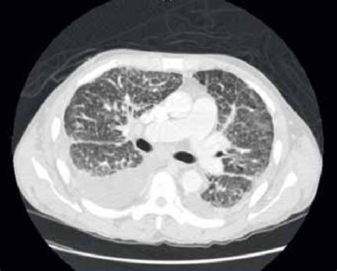 Ct Scan Of The Chest At Presentation Showing Increased Interstitial