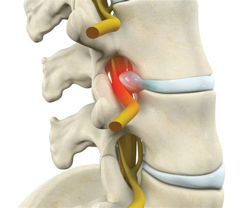 Lumbar Radiculopathy (Nerve Root Compression) • Southwest Florida's Health and Wellness Magazine