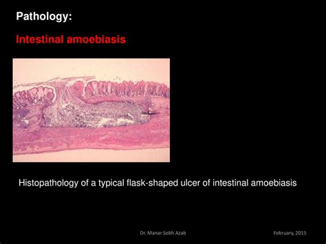 Entamoeba Histolytica Flask Shaped Ulcers