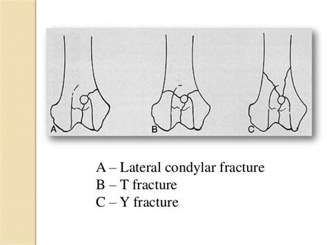 Fracture