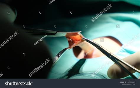 Dorsal Slit Performed During Circumcision Under Stock Photo 1243723369 ...