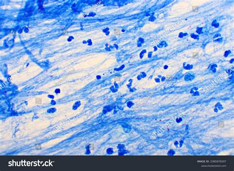 Positive Tb Test Photos, Images & Pictures | Shutterstock