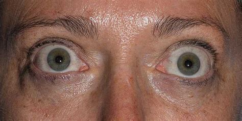 What Is Graves Eye Disease Obn