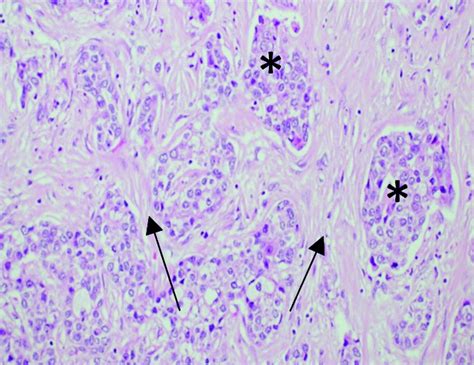 Variant Hepatocellular Carcinoma Subtypes According To The 2019 Who Classification An Imaging