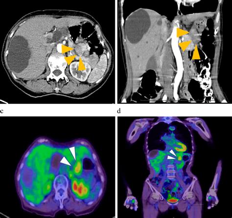 Figure1dynamic Computed Tomography Ct Scan Of The Abdomen A Axial