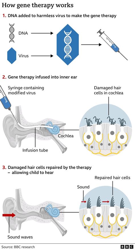 Pioneering Gene Therapy Restores UK Girl S Hearing BBC News