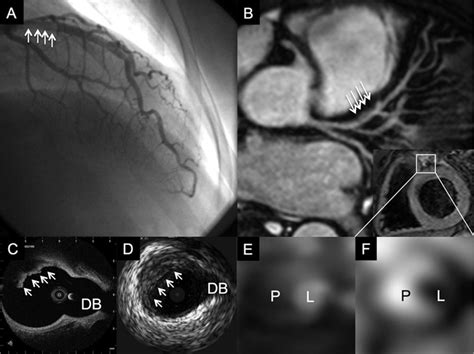 Characterization Of Coronary Atherosclerosis By Magnetic Resonance