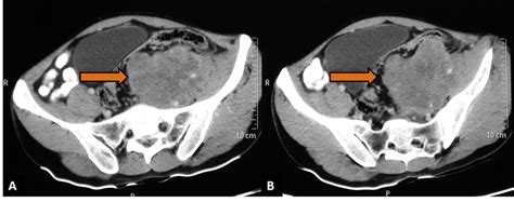 Abaxial Contrast Enhanced Ct Scan Images Showing Heterogeneously