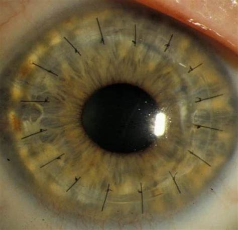 Keratoconus Corneal Transplant