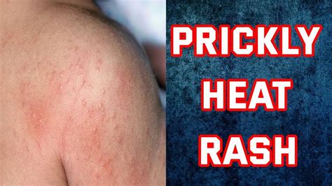 Heat Rash Home Remedies How To Get Rid Of Heat Rash Quickly Youtube