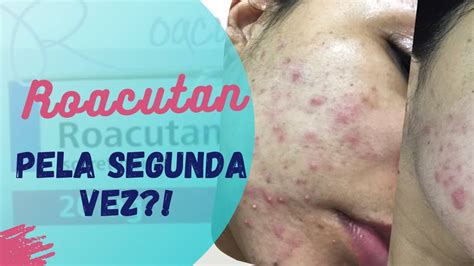 Roacutan Efeitos Colaterais Em Homens - ROACUTAN - As espinhas voltaram?! Os piores efeitos colaterais! # ...