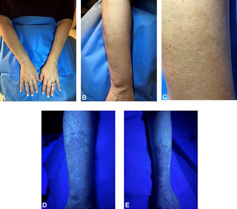 Acquired brachial cutaneous dyschromatosis - JAAD Case Reports