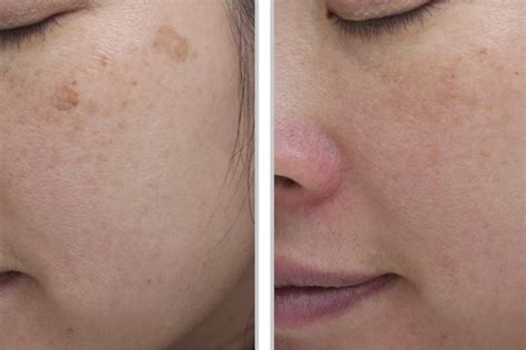 Interested In Radiant Skin The Moxi Laser Can Help Siperstein