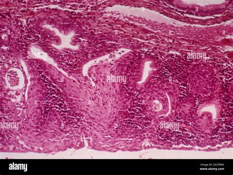 Cervical Squamous Metaplasia Light Micrograph Of A Section Through A