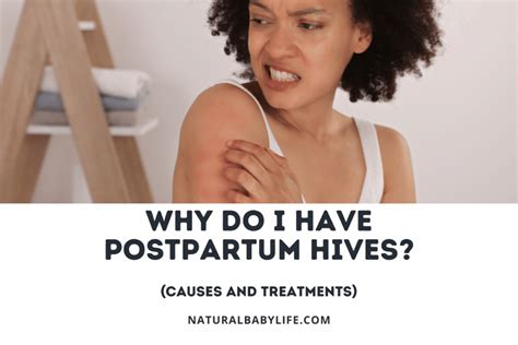 Why Do I have Postpartum Hives? (Causes and Treatments)