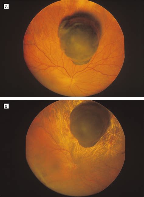 Panoramic Imaging Of The Ocular Fundus Cataract And Other Lens