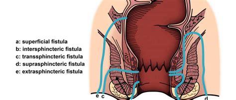 FÍSTULA ANAL Cirugía Sin Fronteras CSF