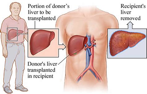 Liver Transplant Criteria Types Surgery And Liver Transplant Survival Rate