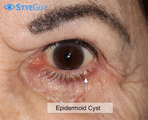 Inclusion Cysts Eyelid