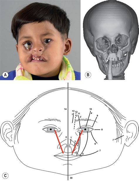 Craniofacial abnormalities - Clinical Tree