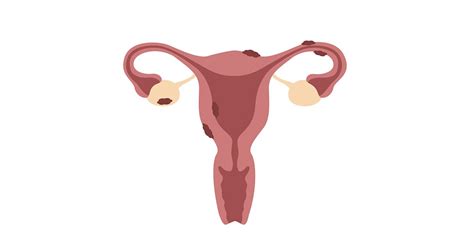 ranzcog welcomes  treatment  management  endometriosis