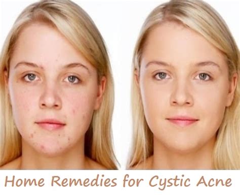 Active Home Remedies How To Get Rid Of Cystic Acne