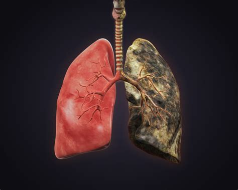 What Is Smoker Lung Difference Between Healthy Lungs