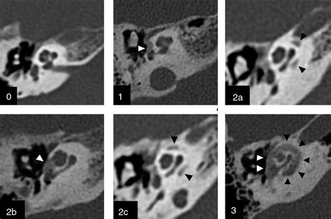 Graduación Por Tc De La Otoesclerosis Clasificación De Symons Y Download Scientific Diagram