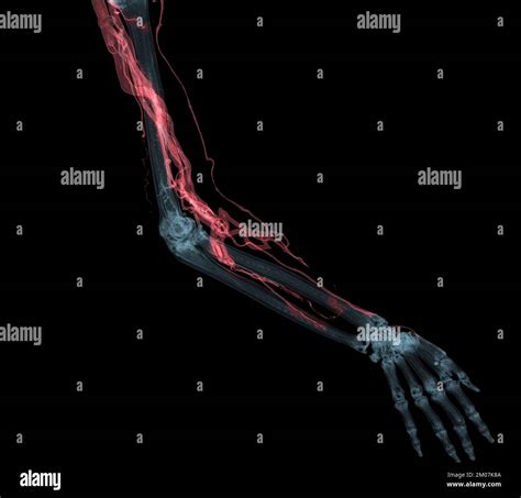 Brachial Arteries Of The Arm With Upper Extremity Bone 3d Rendering