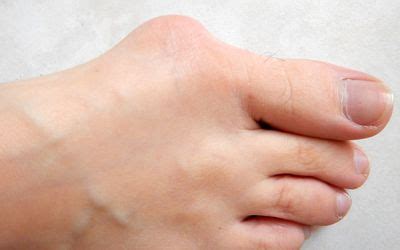 Foot Problems People Mistake For A Bunion