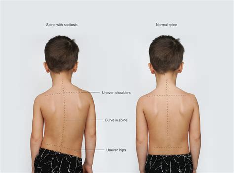 What If My Child Has Scoliosis Palermo Physiotherapy And Wellness