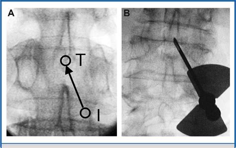 Figure 2 From Fluoroscopic Guided Paramedian Approach For Lumbar Catheter Placement In